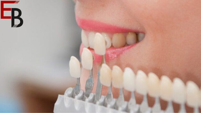 Introduction to Pop-In Veneers for Teeth