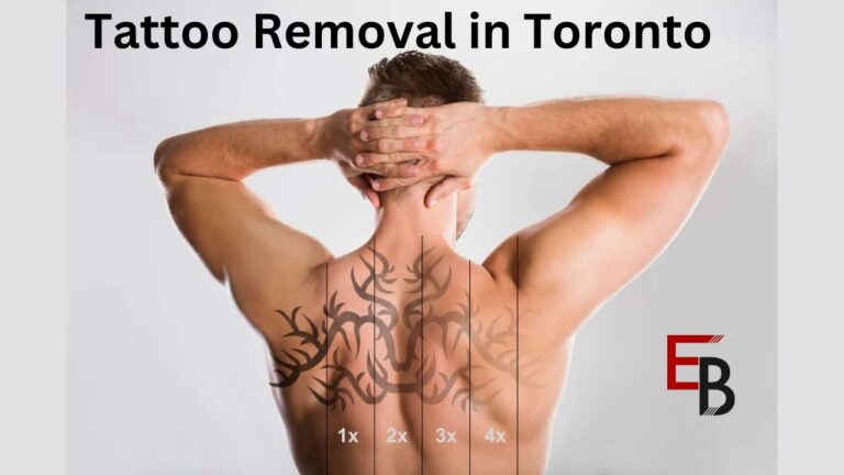 Tattoo Removal in Toronto: A Comprehensive Guide