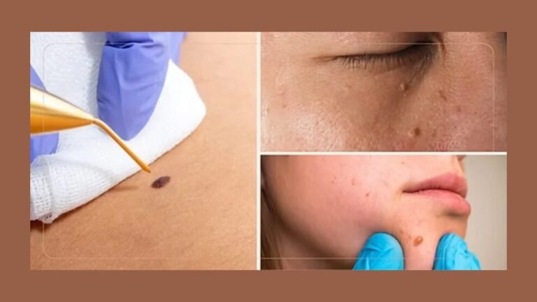 Natural Skin Tags Treatments