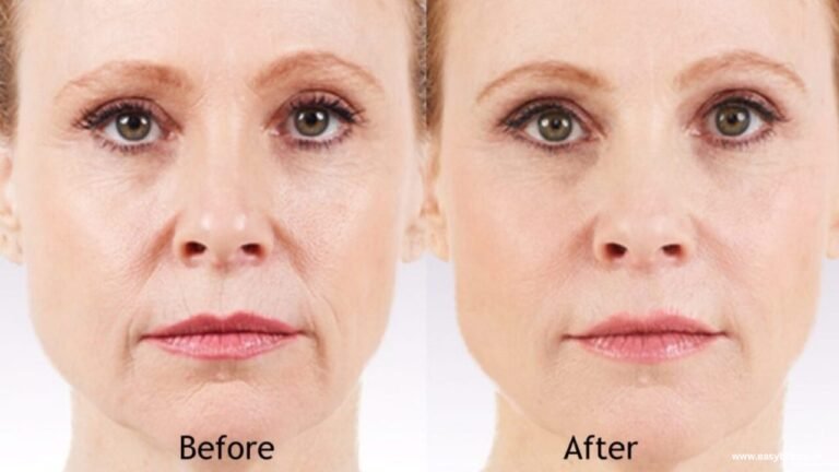 Dermal Fillers