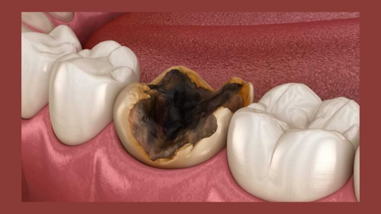 Tooth Decay