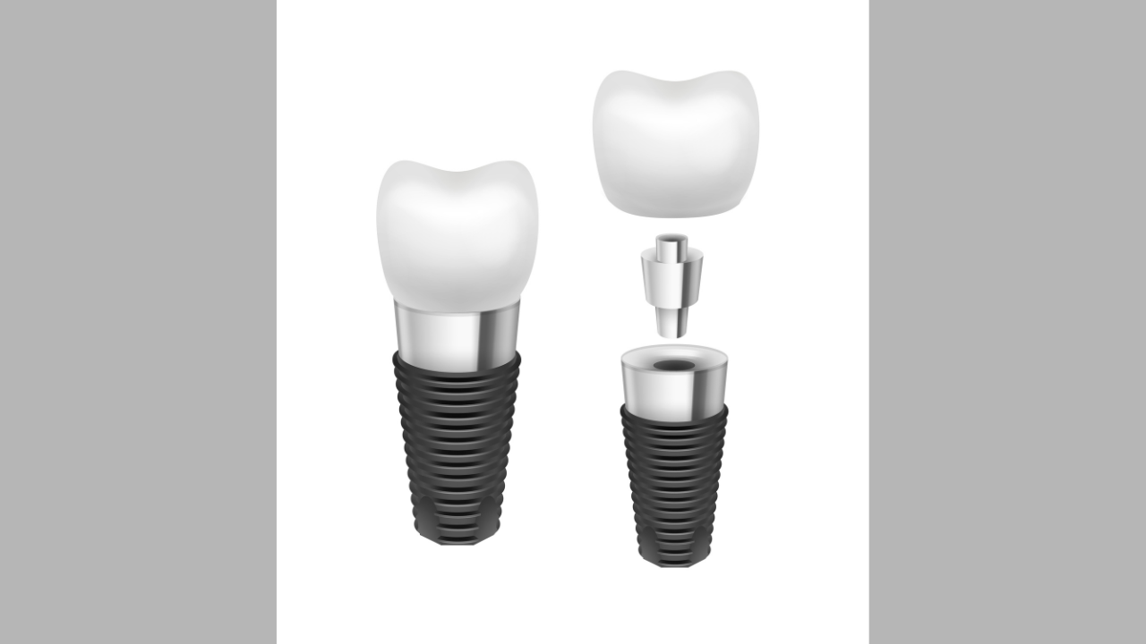 Dental Implants