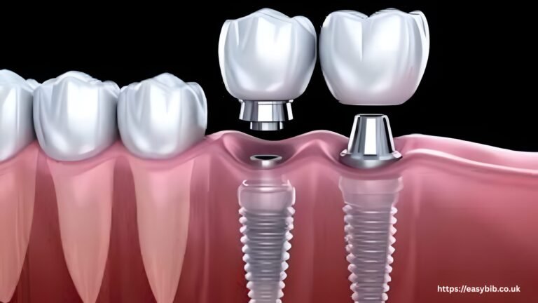Dental Implants