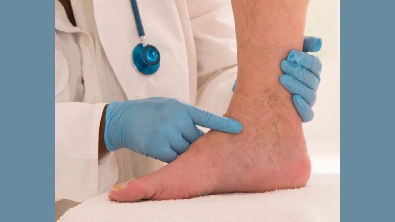 Spider Vein